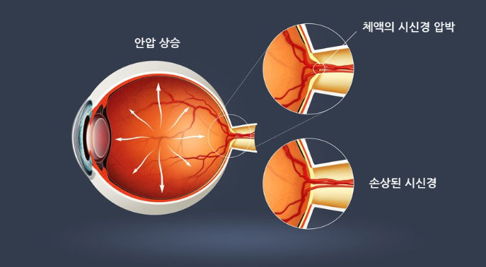 녹내장, 지금! 당신도 모르게 진행되고 있는 소리 없는 시력 도둑! 원인, 증상, 치료방법 알아보기.