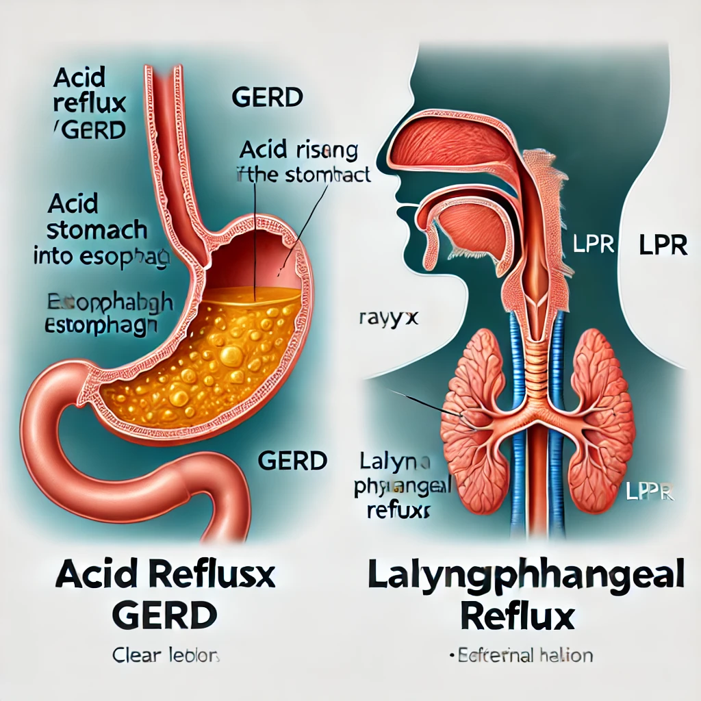 역류성 식도염과 역류성 후두염을 그림으로 표현한 이미지