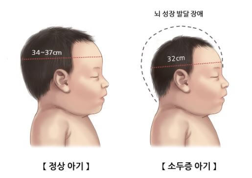 지카바이러스 증상 및 위험성