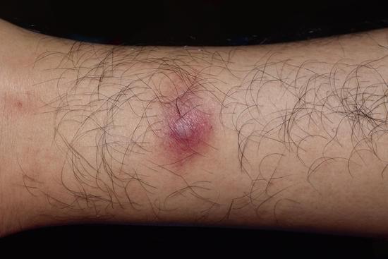 피부 감염 질환 &ndash; 원인, 증상, 치료 방법 정리