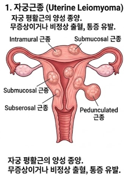 자궁선근증