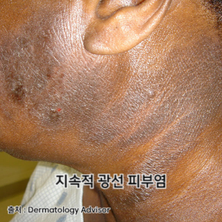 햇빛-알레르기-증상