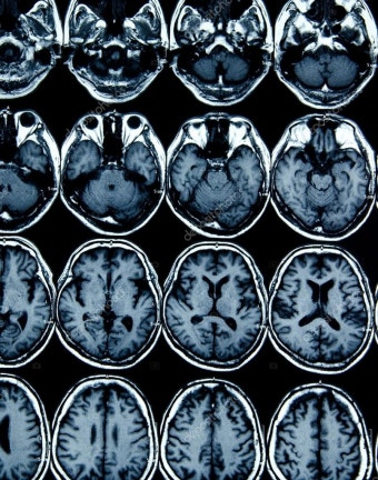 뉴스타트와 뇌 건강