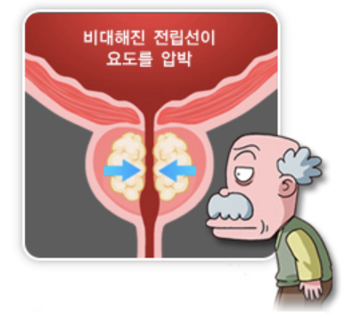 전립선비대증 5
