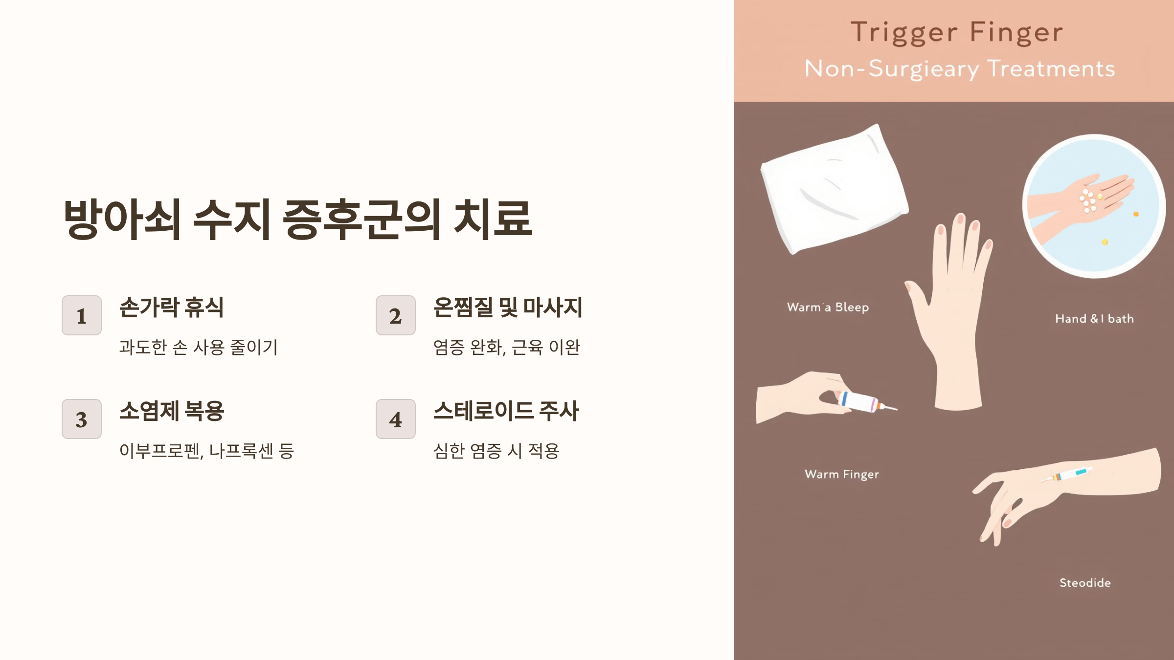 방아쇠 수지 증후군 관련된 사진입니다.