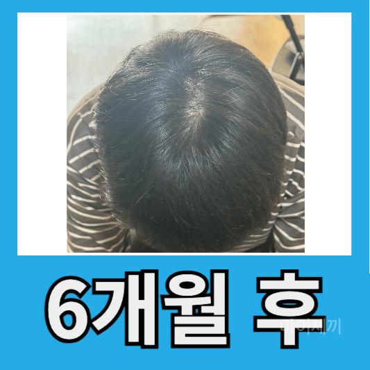 "내돈내산 탈모 치료 6개월 후기"