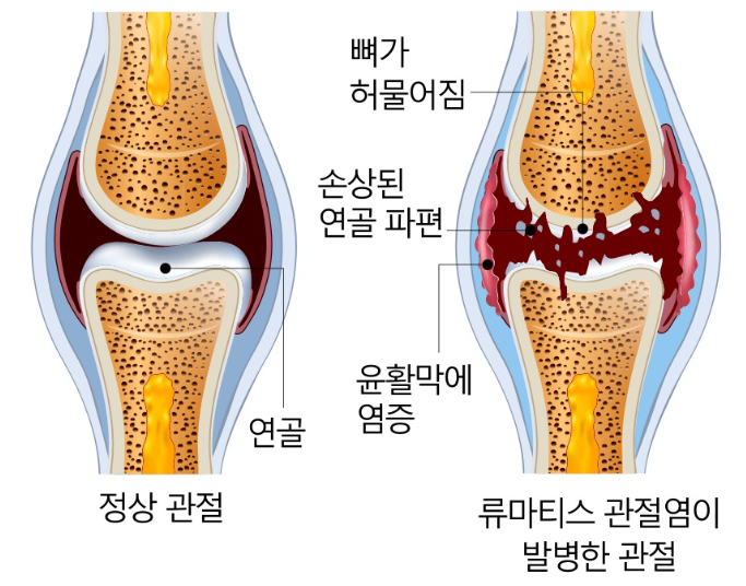 관절염의종류