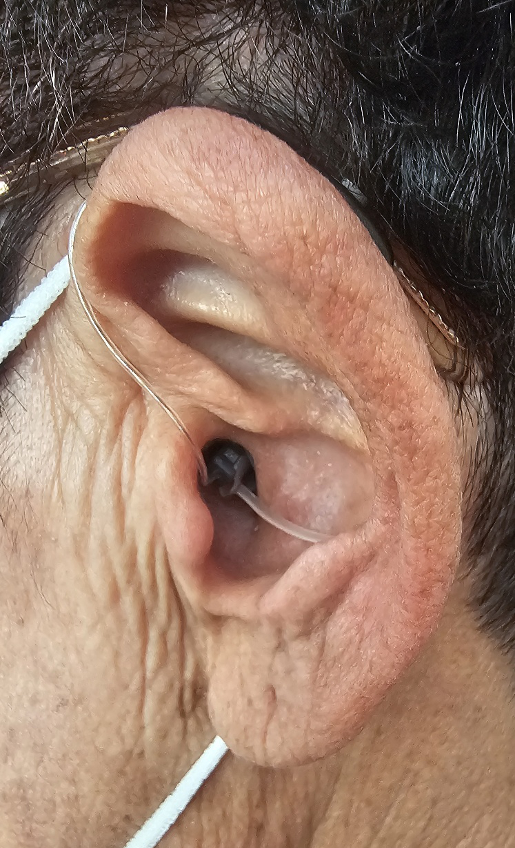 오픈형 보청기 착용 사진입니다