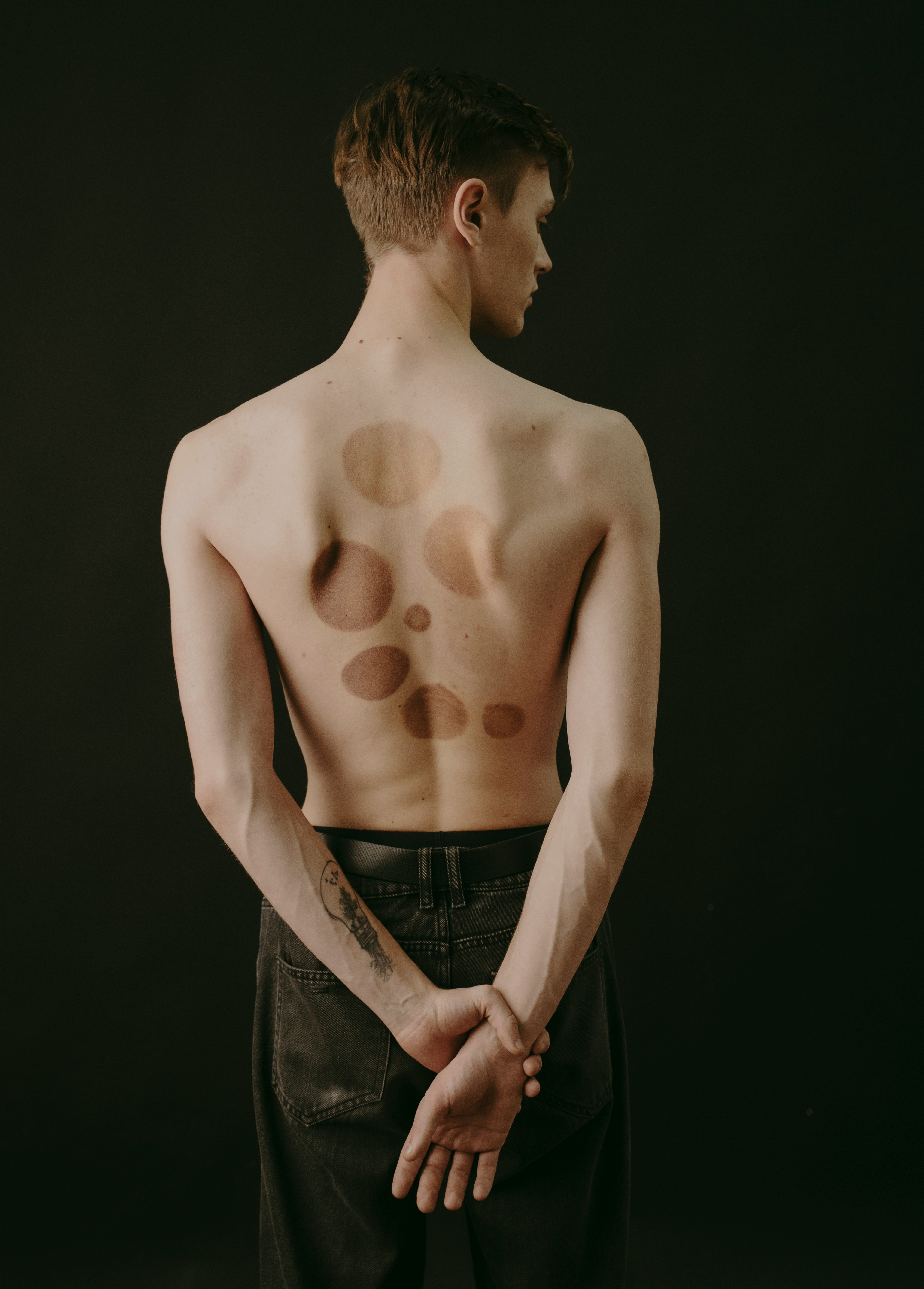 등에 멍 자국이 있는 남성