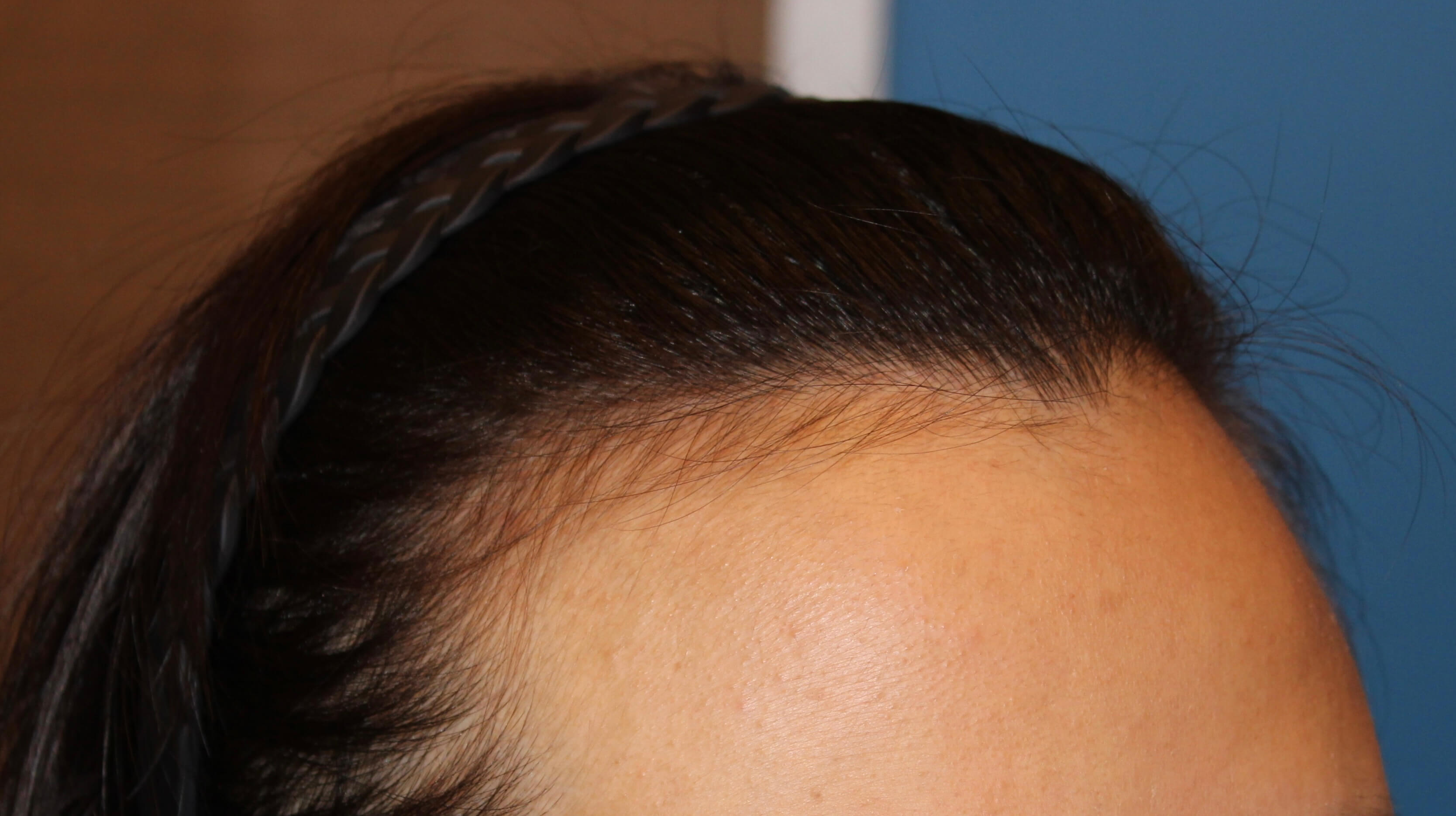 여자 헤어라인 수술 전