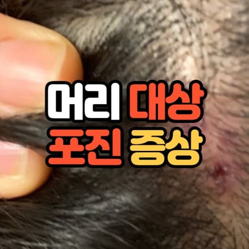 머리 대상포진 증상