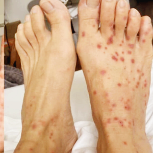 엠폭스 관련주 대장주 TOP10 : 원숭이두창