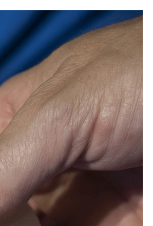 손가락마디통증