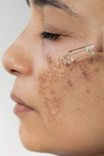 검버섯 기미 차이 없애는 방법 법 레이저 연고 박피 크림