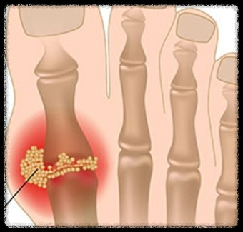 극심한 고통의 통풍