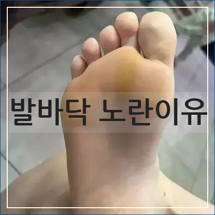 발바닥 노란이유
