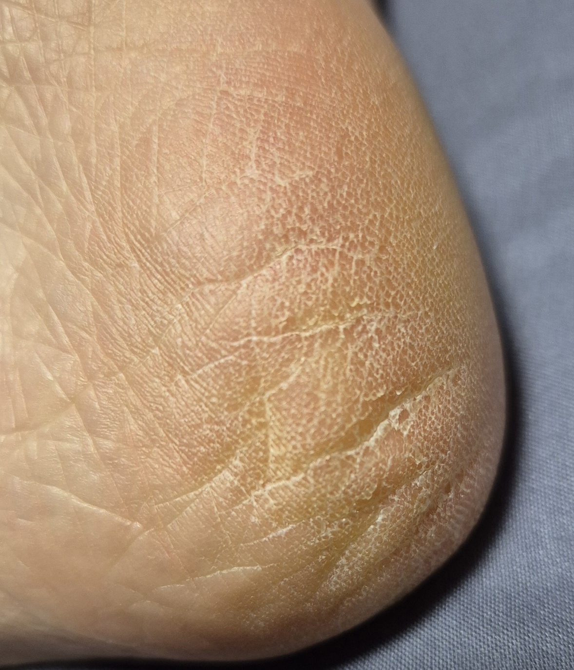 건조해서 갈라진 발뒤꿈치 모습