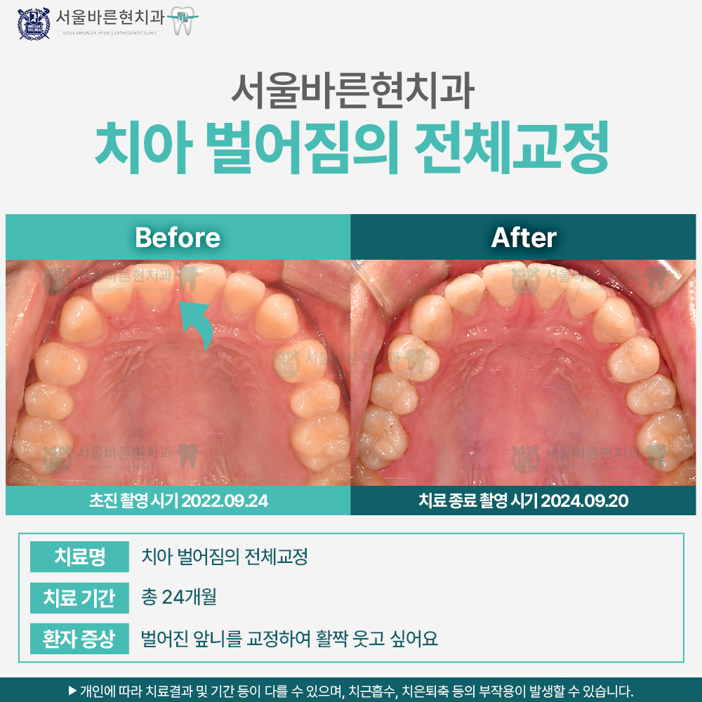 부산치아교정