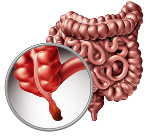 맹장염 복강경 수술 비용
