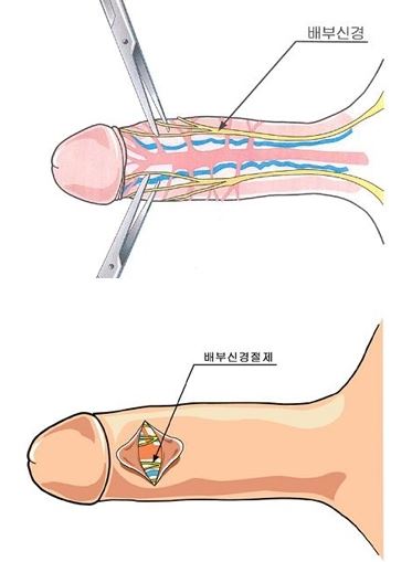 조루 예시 사진