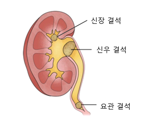 신장 결석 증상