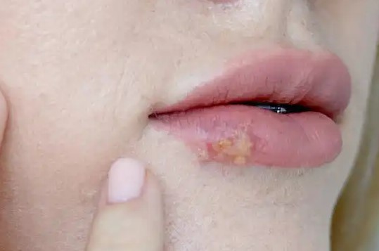 헤르페스 1형 치료 약 연고 