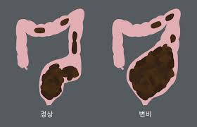 여자 왼쪽 아랫배 통증 원인 7가지 왼쪽 아랫배 땡김 콕콕 찌릿 증상 