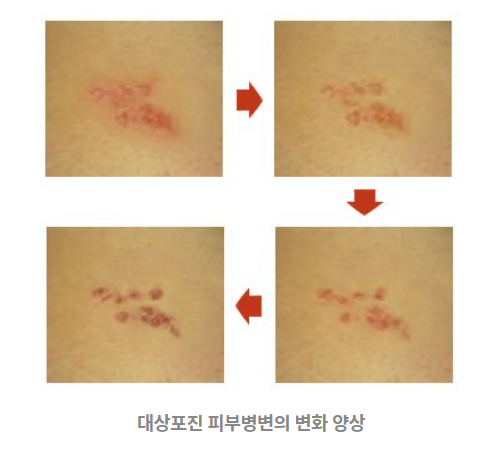 대상포진 초기증상
