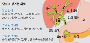 담석