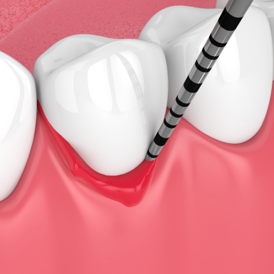 치주염의 원인과 증상, 특징, 치료법 및 예방 방법