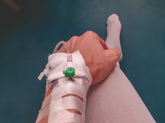 컴파트먼트 증후군 구획 압력 측정 기준