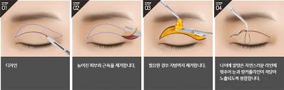상안검 수술 비용