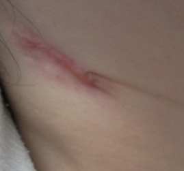 임파선염 증상 28