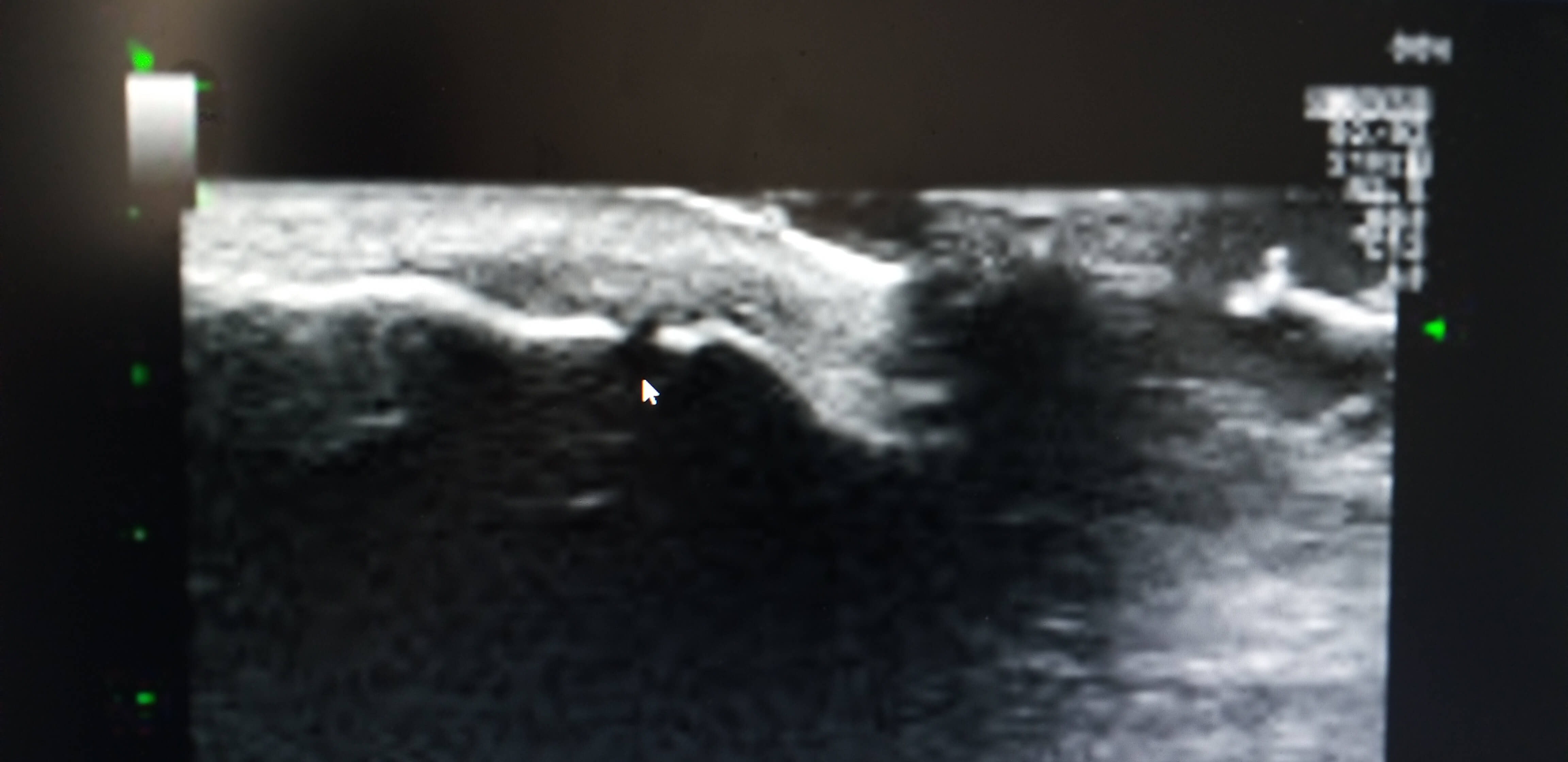 인대파열초음파사진3
