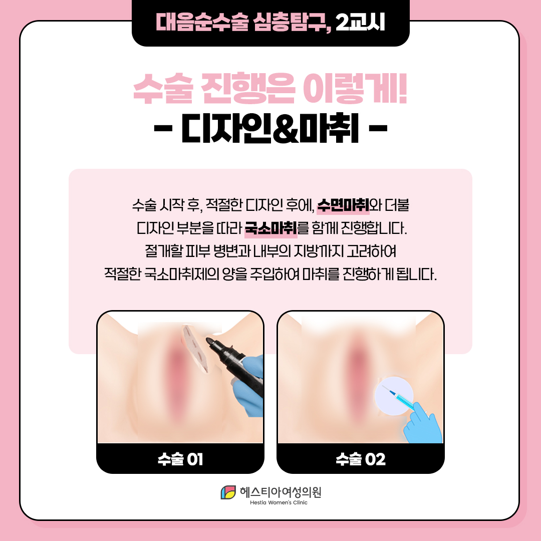대음순수술 수술 진행