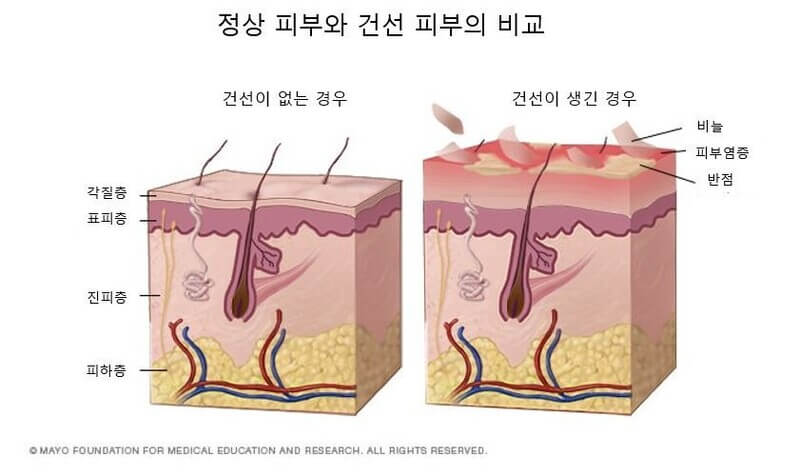 건선 증상과 자가치료