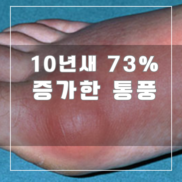 10년새 73% 증가한 통풍