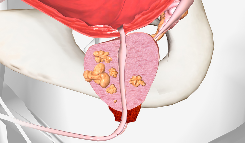 소변이 자주 마려운 증상