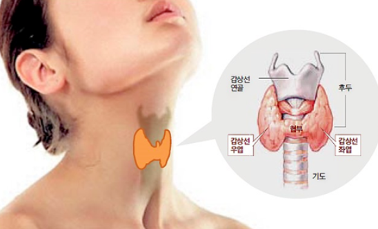 갑상선기능항진증