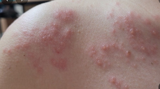 대상포진 초기증상 관련 사진