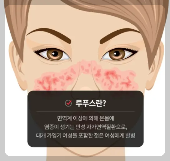 루푸스