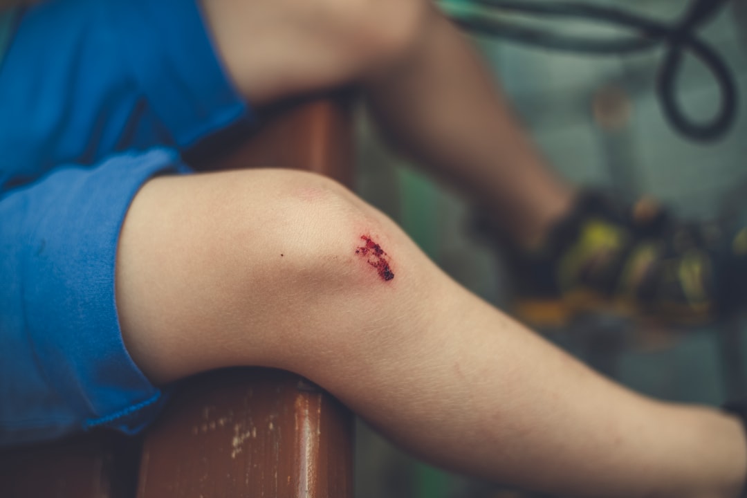 Sprain
