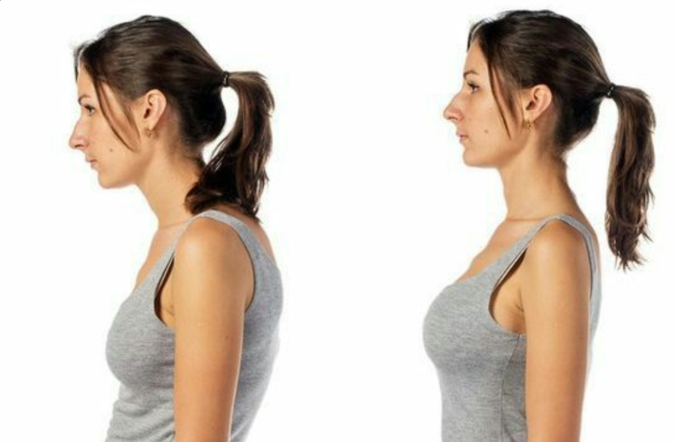 거북목증후군 여성