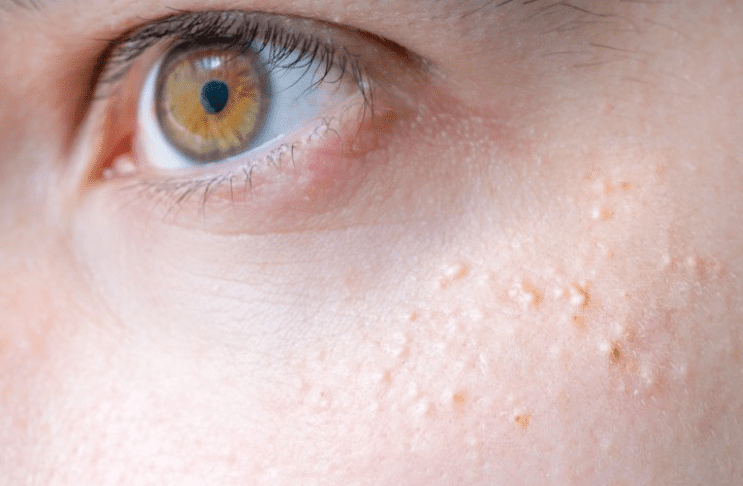 좁쌀여드름-모습