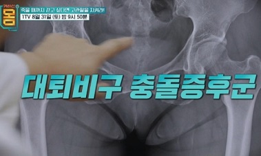 고관절