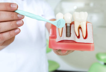 임플란트 뼈이식