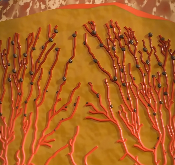 곤지름 초기증상