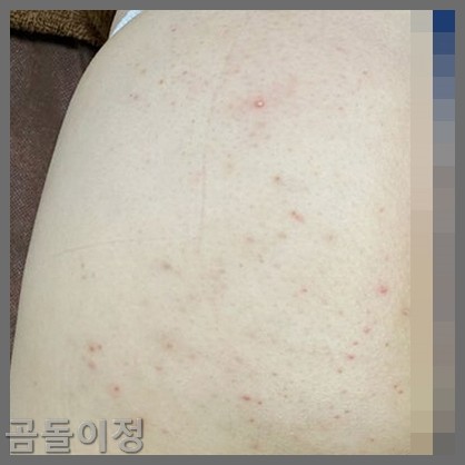 성인 엉덩이 두드러기 땀띠 뾰루지, 병원 안 가고 해결한 방법