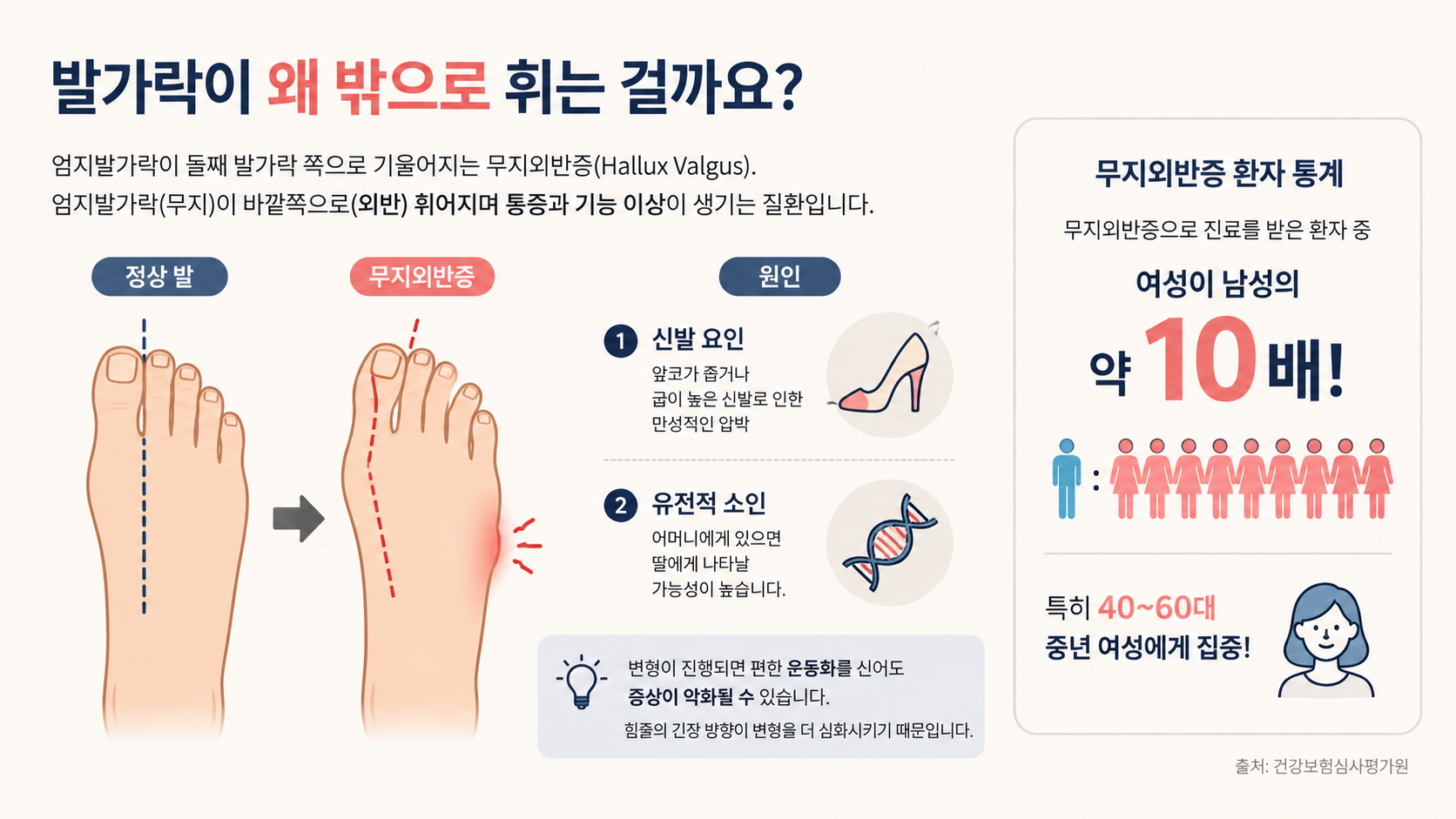 무지외반증 (발 변형, 신발 선택, 예방 관리)