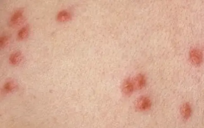 빈대 예방 및 퇴치